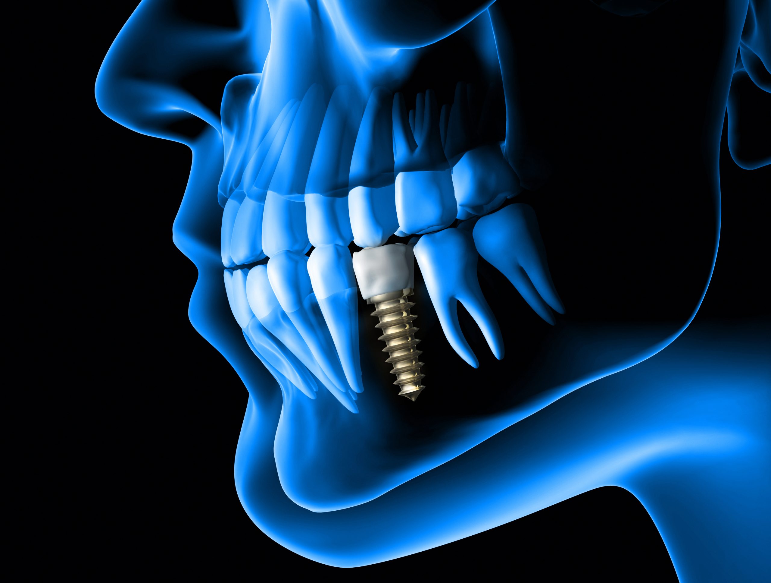What Are Dental Implants?